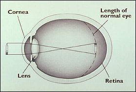 Nearsightedness 